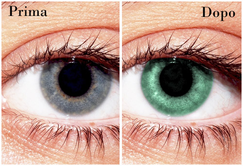 Operazione Per Cambiare Il Colore Degli Occhi